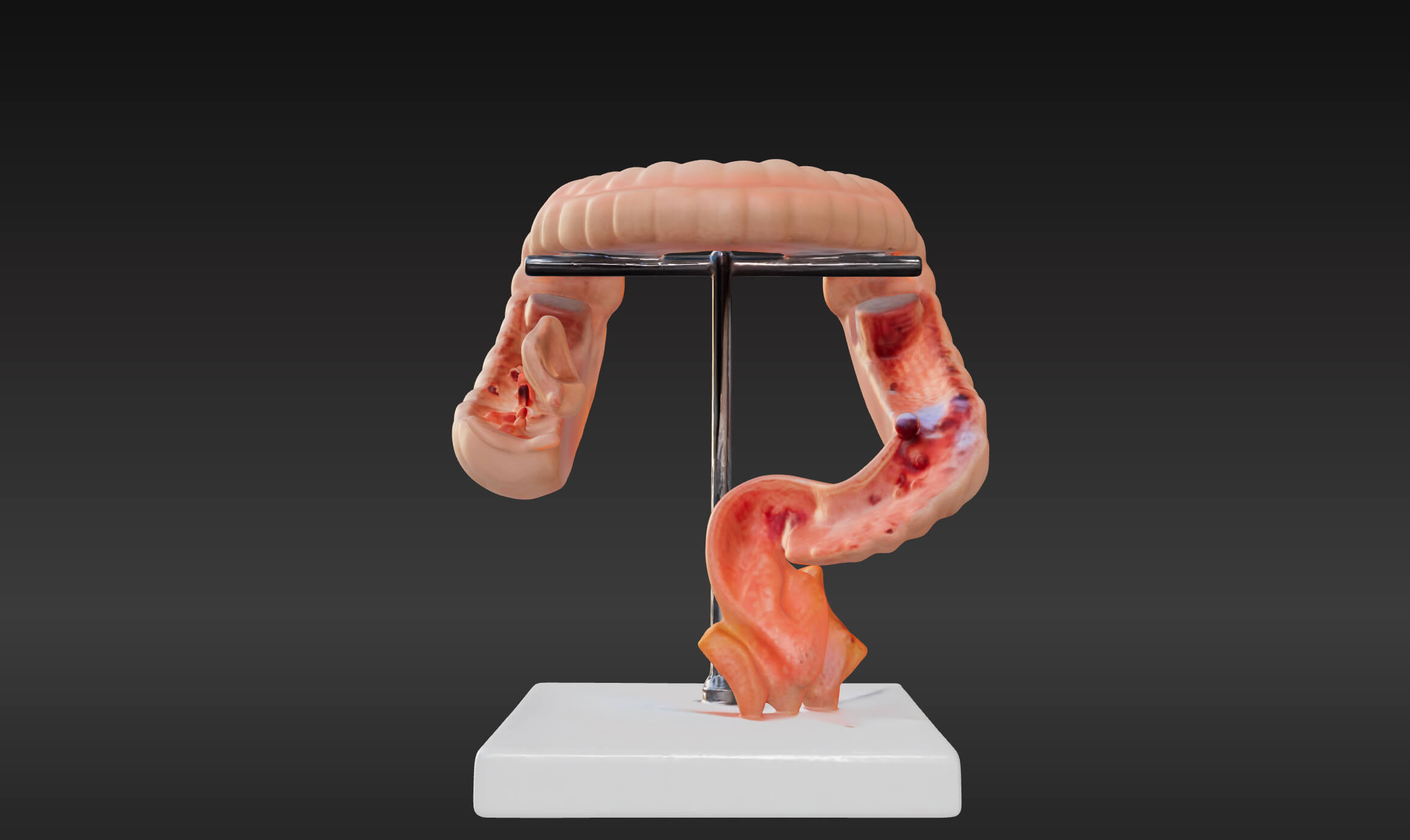 3D Model of Intestinal Diseases by azekapeka