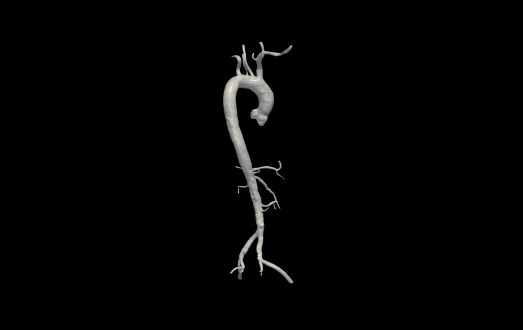 3D Model of Aorta and Aortic Vessel Tree by azekapeka