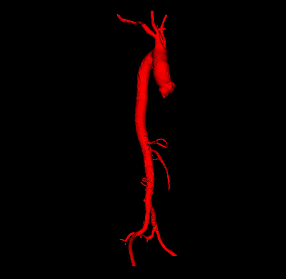 3D Model of Aorta and Aortic Vessel Tree by azekapeka