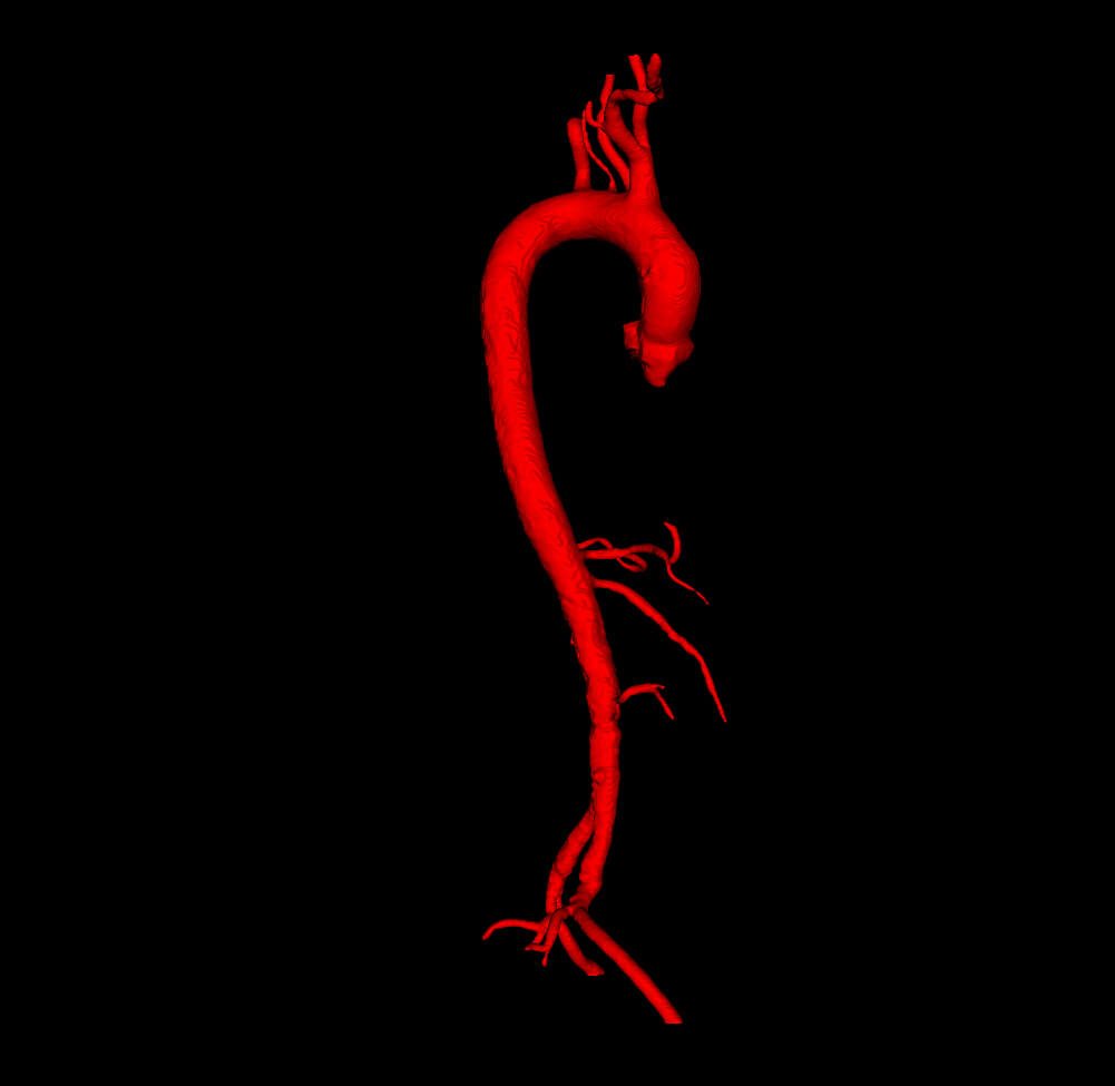 3D Model of Aorta and Aortic Vessel Tree by azekapeka