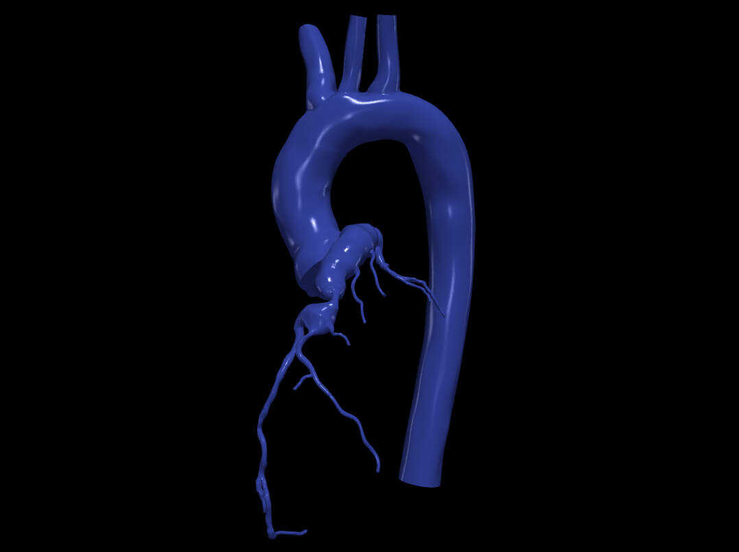 3D Model of Aorta and Coronary Arteries by azekapeka