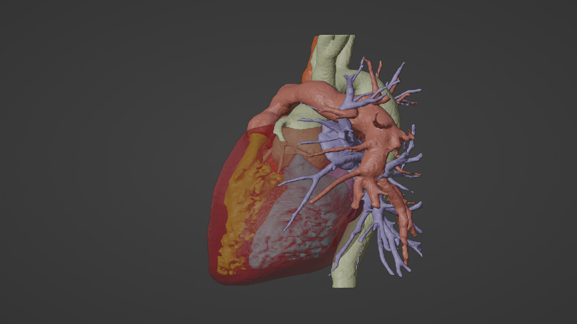 Transposed Organs 3D Model of Human Heart With Transposition of Great Arteries by azekapeka