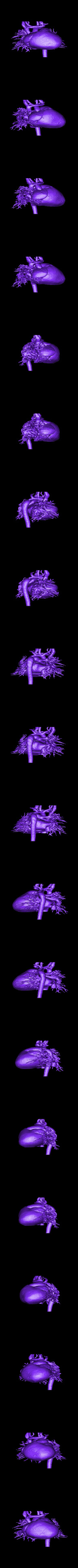 3D Model of Human Heart With Ventricular Septal Defect (Vsd) by azekapeka