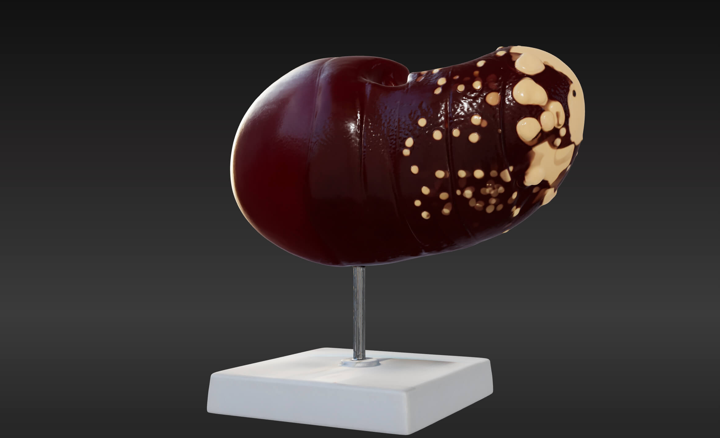 3D Model of Human Liver With The Progression of Liver Diseas by azekapeka