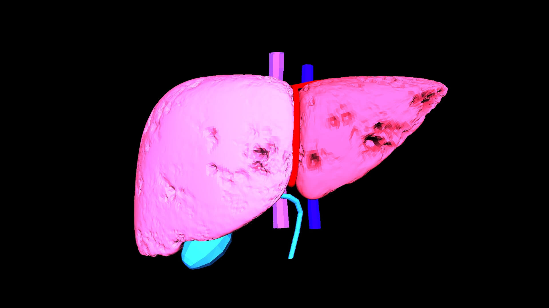 3D Model of Liver With Fibrosis by azekapeka