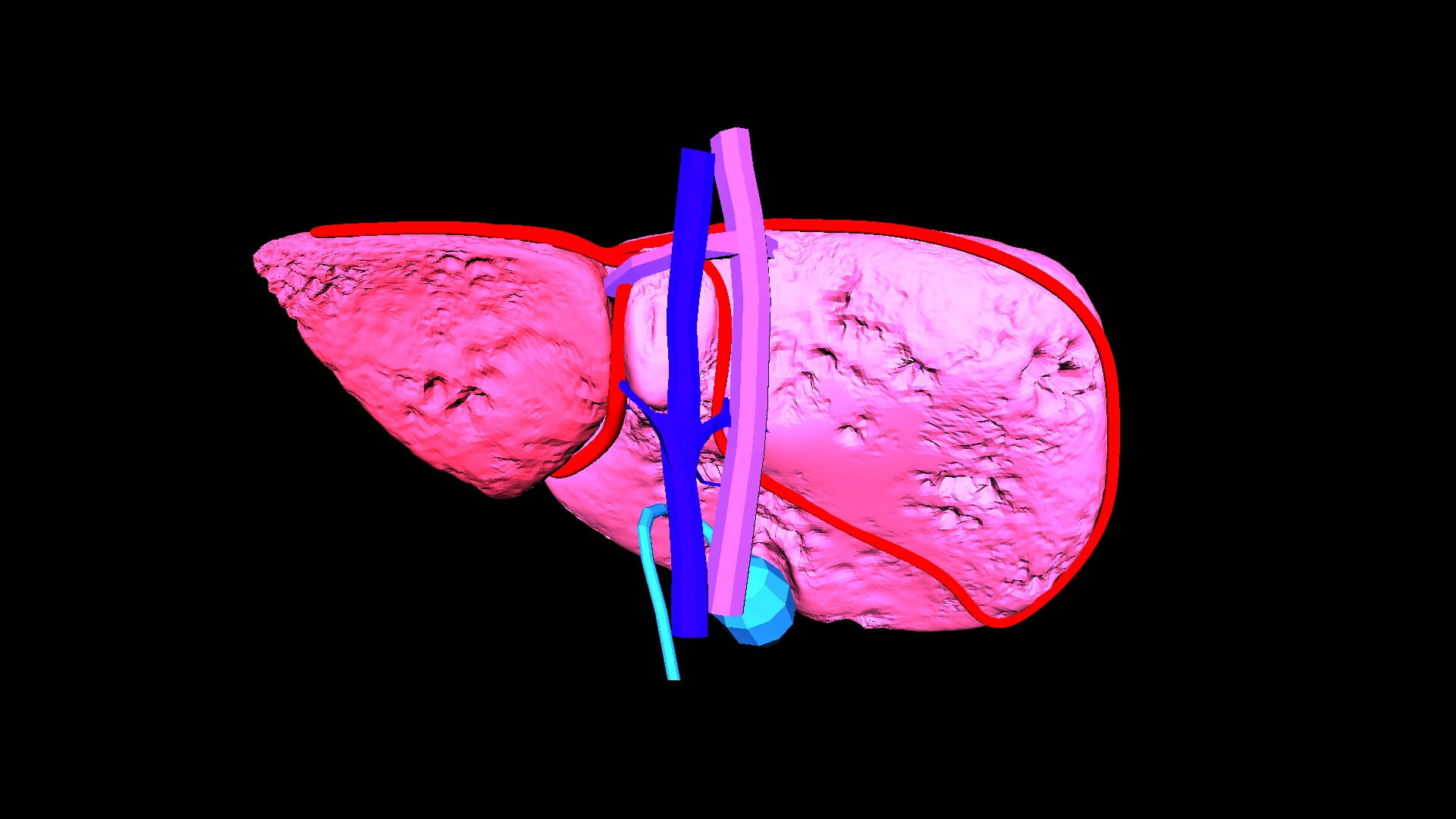 3D Model of Liver With Fibrosis by azekapeka