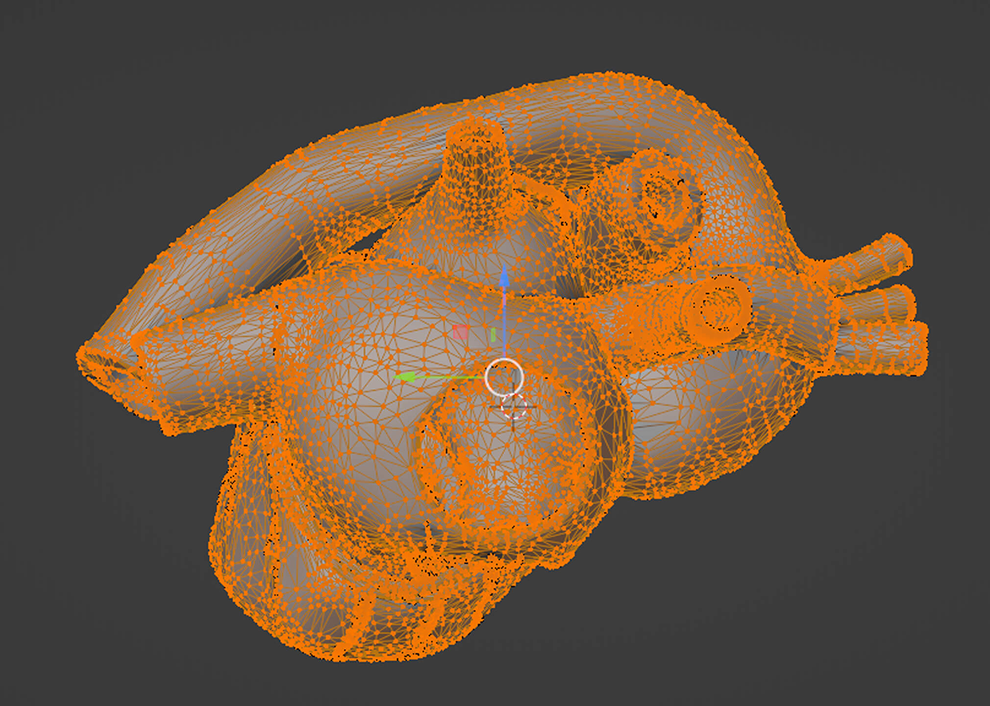 3D Model of Partial Anomalous Pulmonary Venous Connection by azekapeka