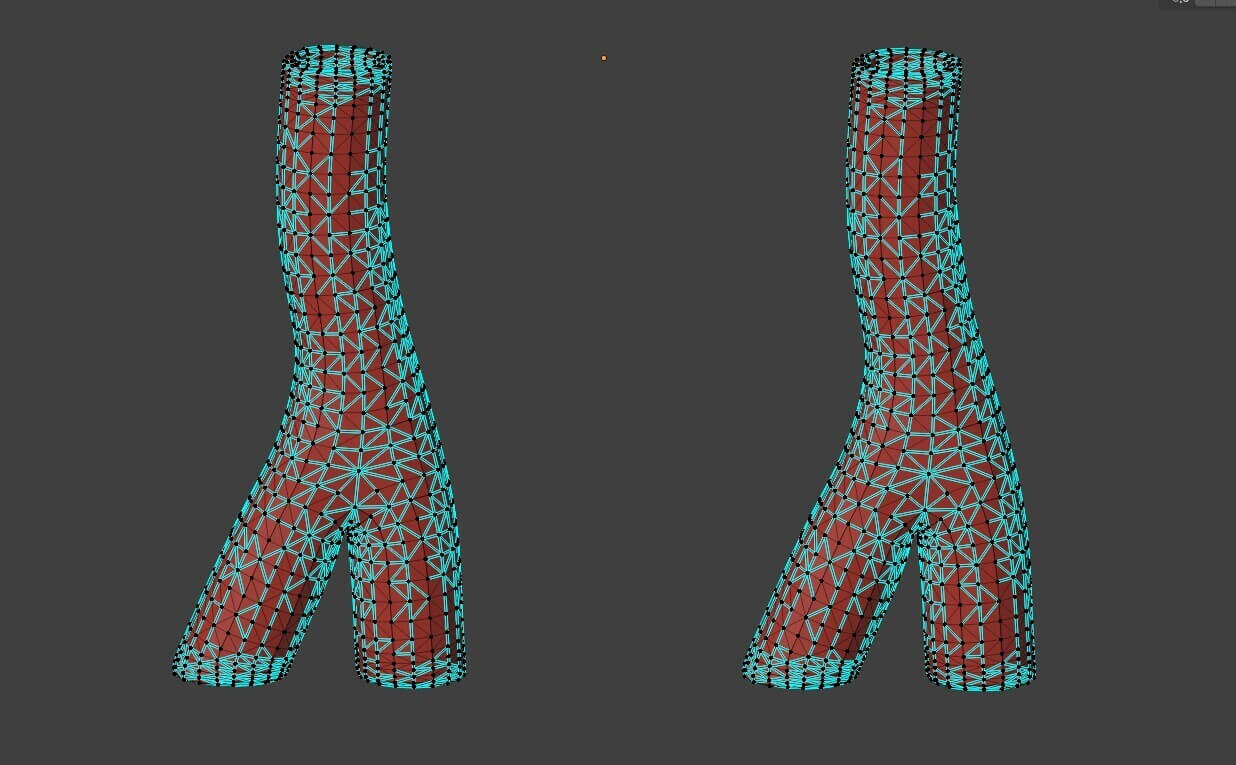 3D Model of Peripheral Artery Disease by azekapeka