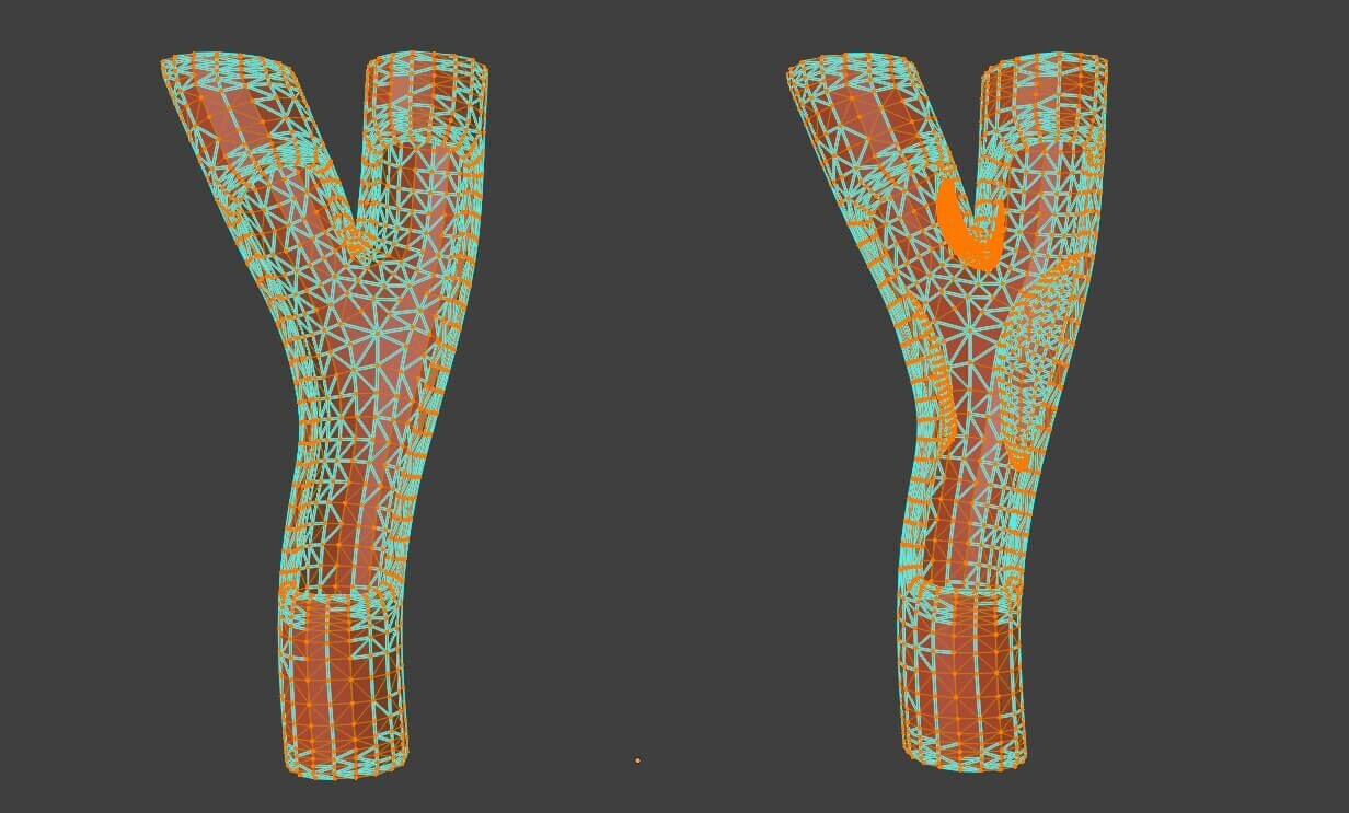 3D Model of Peripheral Artery Disease by azekapeka