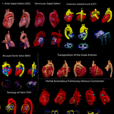 Congenital Heart Disease - 7Pack 3D Model by azekapeka