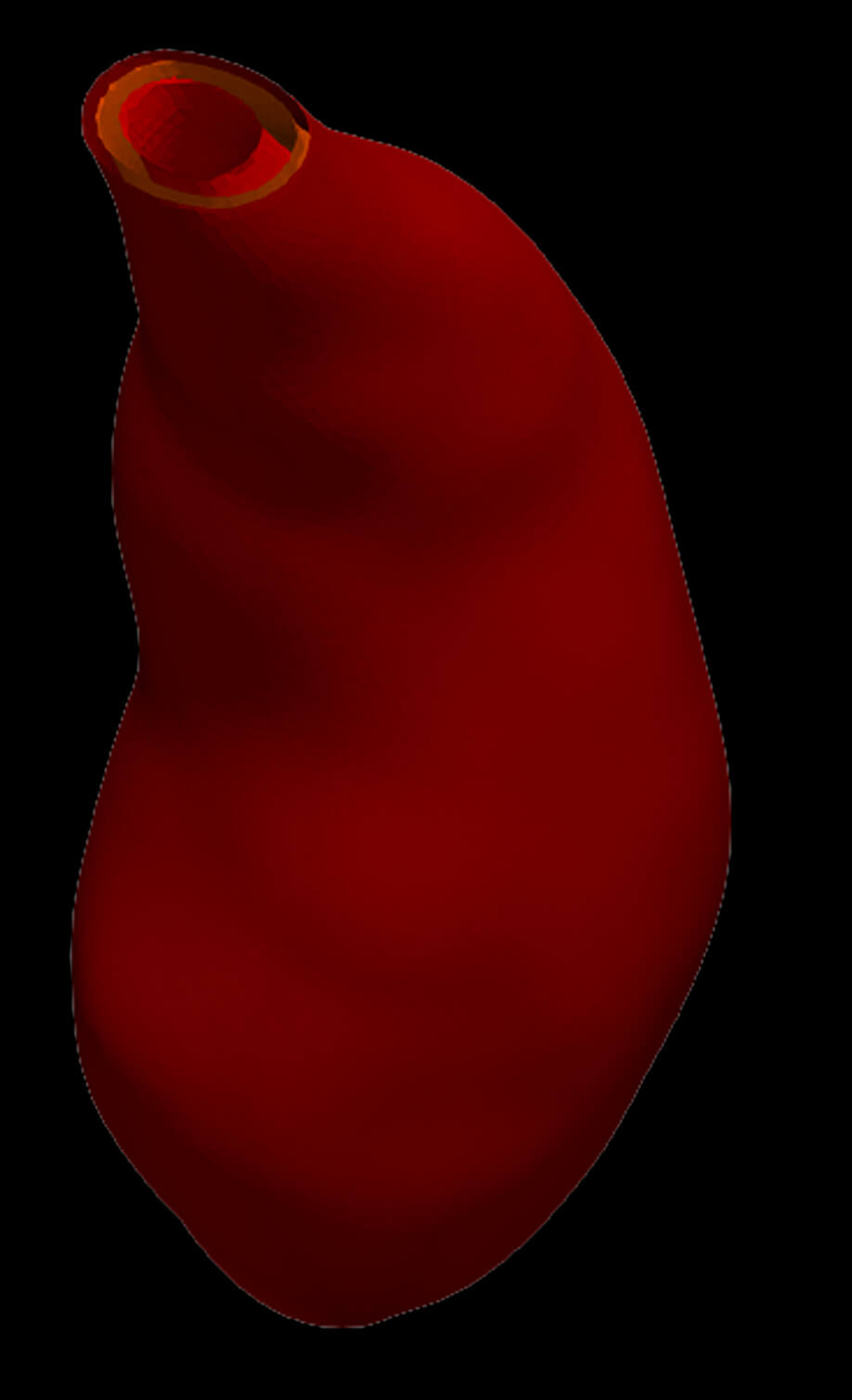 Model of an Abdominal Aortic Aneurysm From a Real Patient by azekapeka