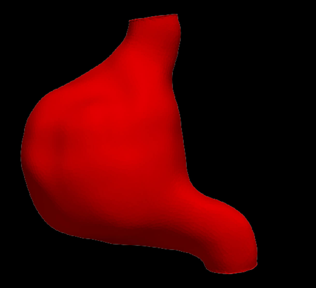 Model of an Abdominal Aortic Aneurysm From a Real Patient by azekapeka