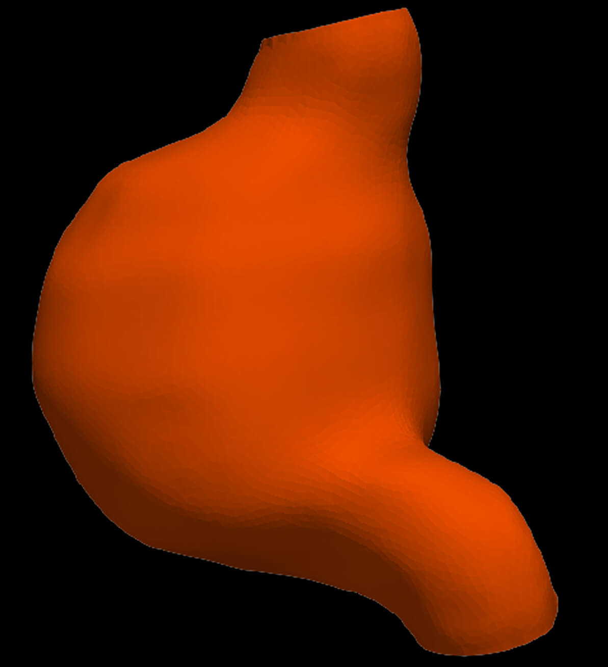 Model of an Abdominal Aortic Aneurysm From a Real Patient by azekapeka