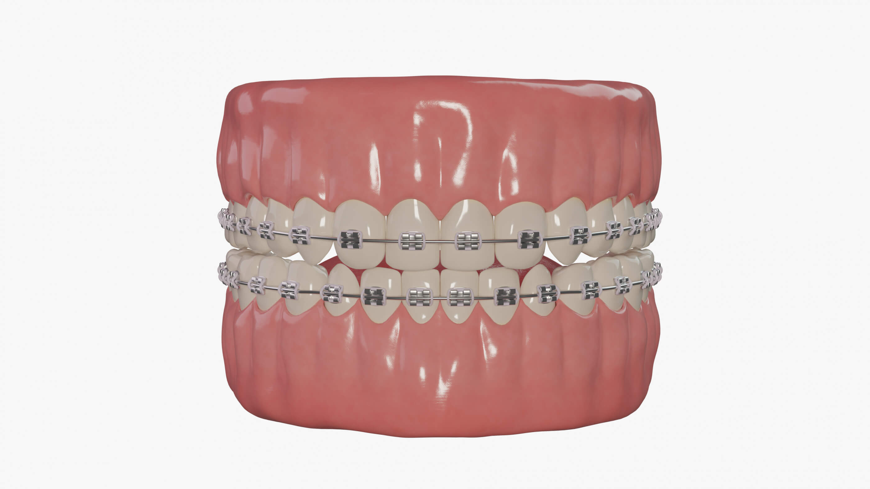 Braces With Elastic Rubber Bands 3D Model by esfey