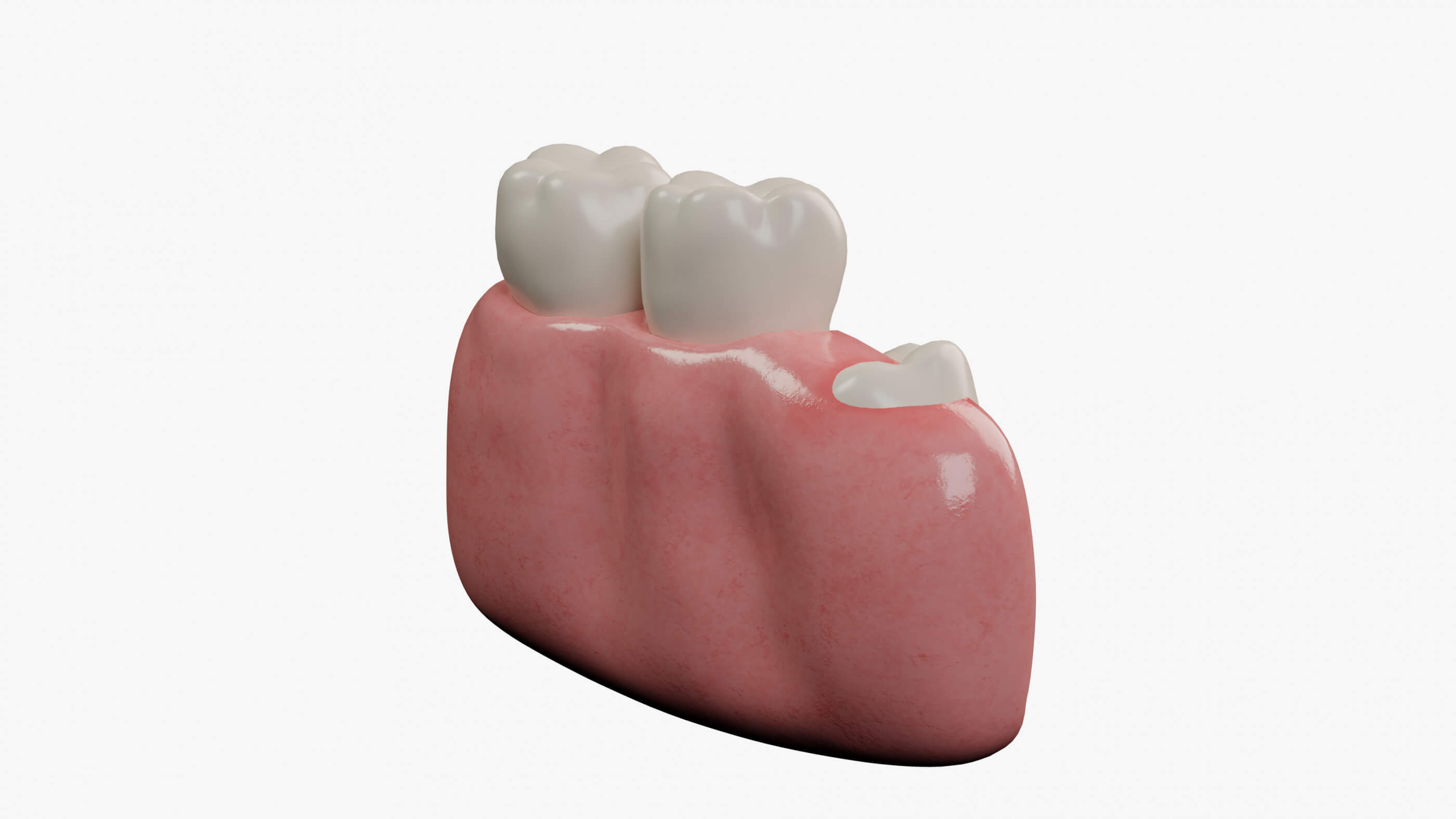 Impacted Molar Incision - 3D Model by esfey