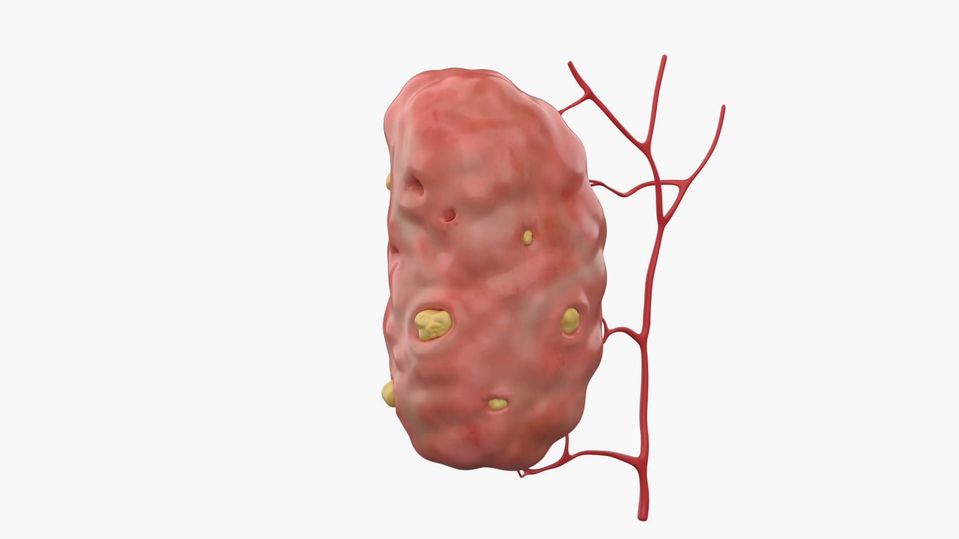 Palatine Tonsil With Tonsilloliths 3D Model by esfey