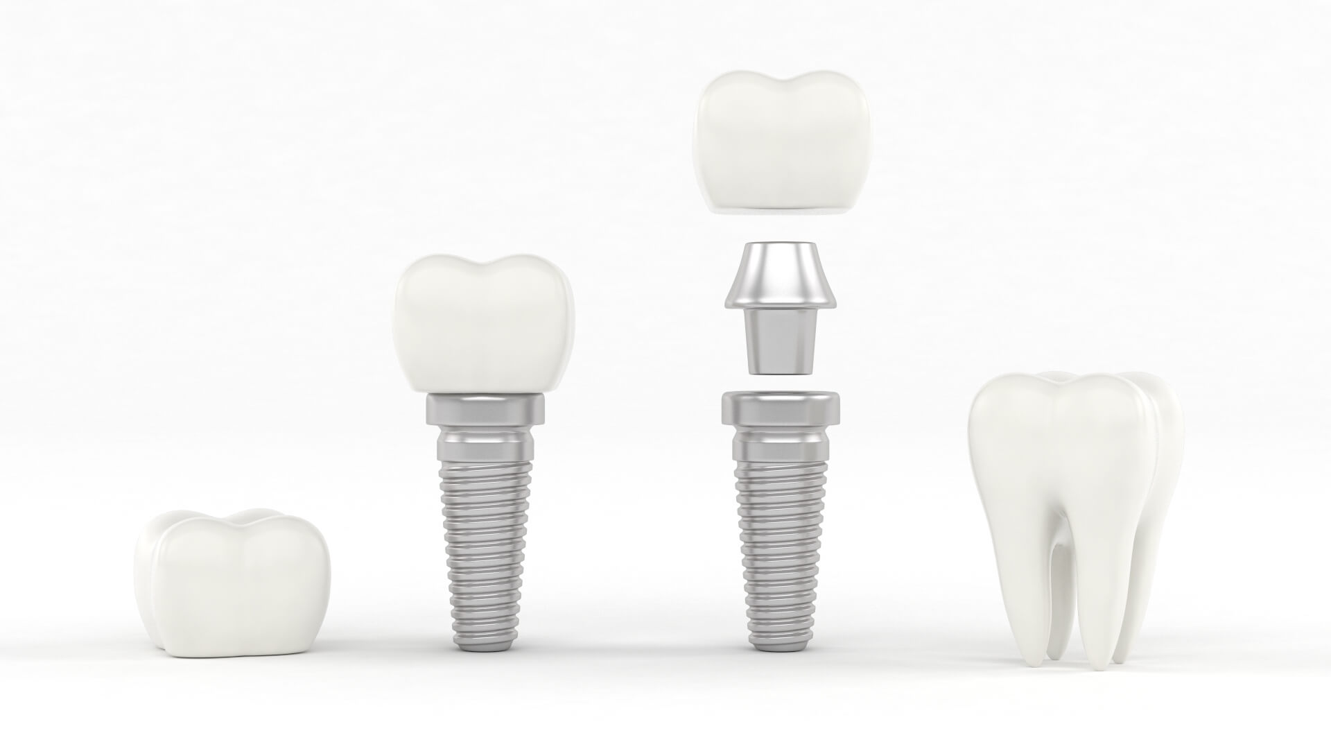 Navigating Dental Implant Choices for Long-Term Oral Health