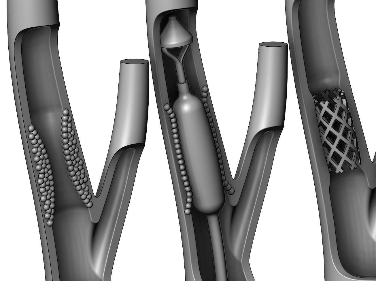 Carotid Artery Stenting Procedure Diorama - 3D Model by RachidSW