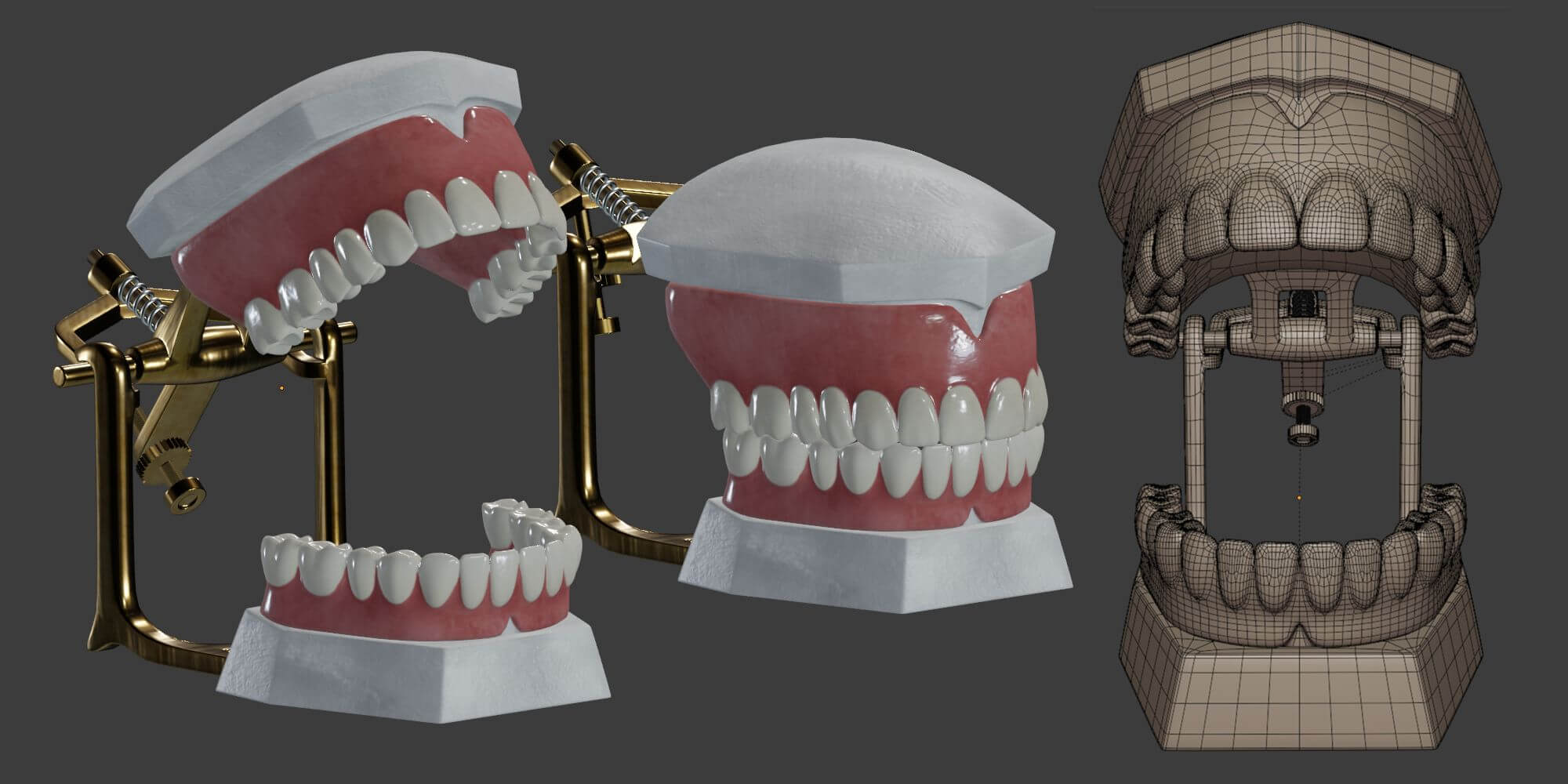 Dental Prosthesis - 3D Model by rossty3d