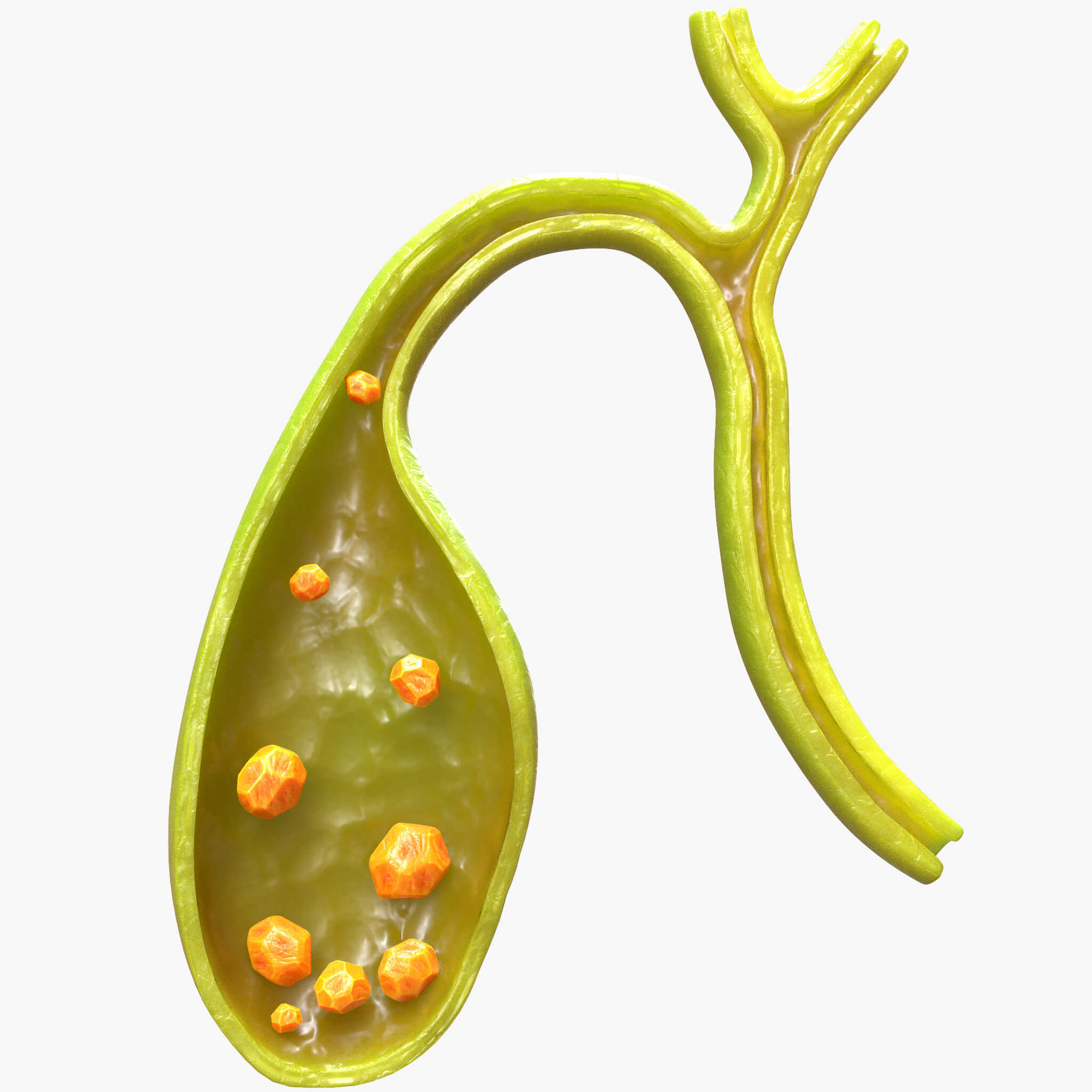 Gallbladder With Gallstones 3D Model by zames1992d